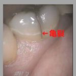 歯が縦に割れている歯根破折｜高松市の歯を削らない治療なら吉本歯科医院